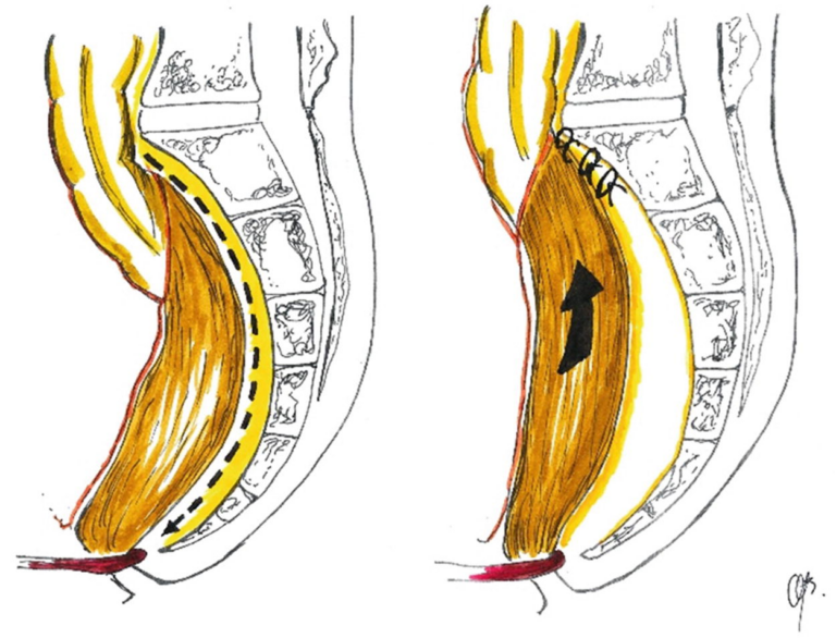 Laparoscopic Suture Rectopexy | Colorectal Unit